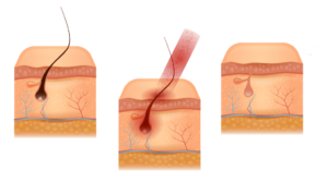 آکادمی تخصصی پوست و مو زیبایی گود اسکین,ریموو تتو با لیزر,لیزر واریس,پیرسینگ,فیبروز ابرو,میکروبلیدینگ,دستگاههای پوستی,پاکسازی پوست,موهای زیر پوستی,جوش باز,موهای زائد هورمونی