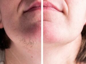 آکادمی تخصصی پوست و مو زیبایی گود اسکین,ریموو تتو با لیزر,لیزر واریس,پیرسینگ,فیبروز ابرو,میکروبلیدینگ,دستگاههای پوستی,پاکسازی پوست,موهای زیر پوستی,جوش باز,موهای زائد هورمونی