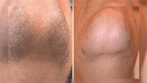 آکادمی تخصصی پوست و مو زیبایی گود اسکین,ریموو تتو با لیزر,لیزر واریس,پیرسینگ,فیبروز ابرو,میکروبلیدینگ,دستگاههای پوستی,پاکسازی پوست,موهای زیر پوستی,جوش باز,موهای زائد هورمونی