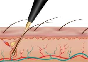 آکادمی تخصصی پوست و مو زیبایی گود اسکین,ریموو تتو با لیزر,لیزر واریس,پیرسینگ,فیبروز ابرو,میکروبلیدینگ,دستگاه‌های پوستی,پاکسازی پوست,موهای زیر پوستی