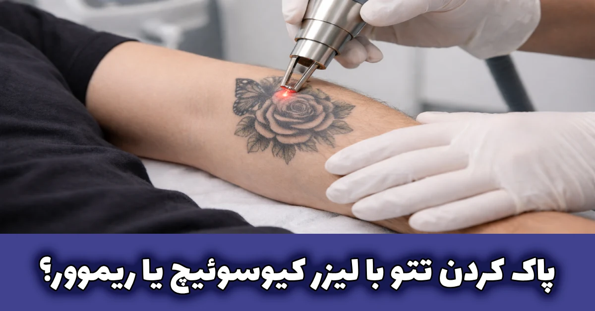 پاک کردن تتو با لیزر کیوسوئیچ یا ریموور