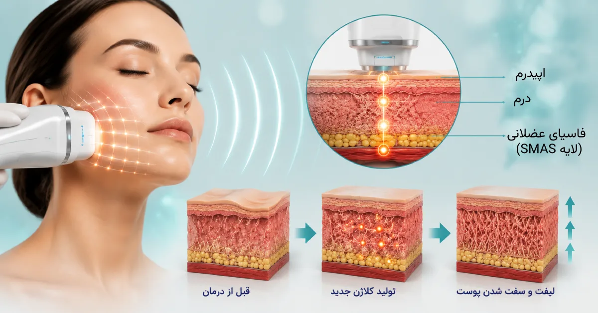 نمای علمی و واقعی از هایفوتراپی صورت با دستگاه اولتراسوند، نمایش نفوذ امواج به لایههای عمیق پوست و تحریک تولید کلاژن برای سفت شدن و لیفت پوست
